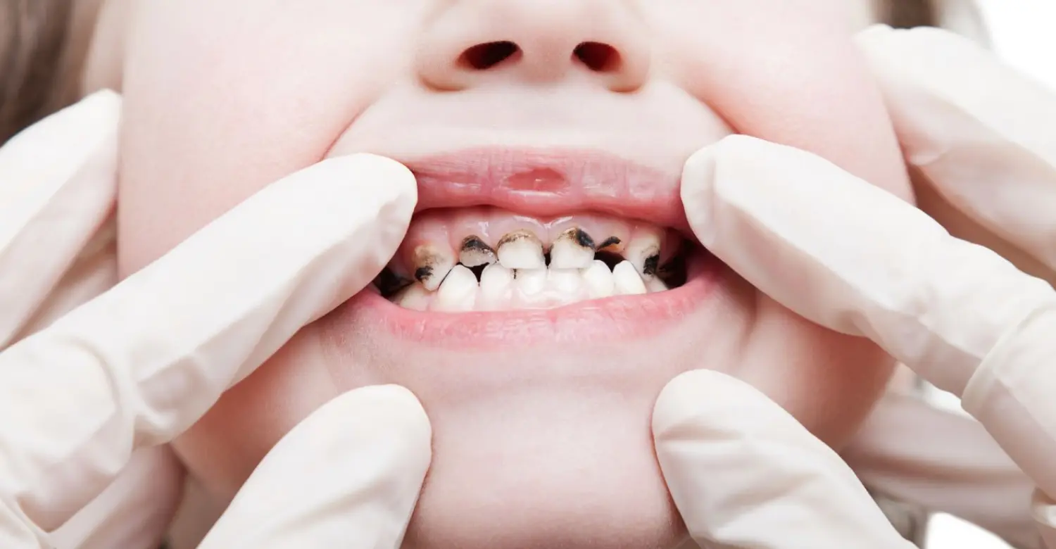 Child Tooth Decay 2
